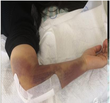 中药泡脚：缓解疼痛肿胀的神奇疗法，你试过吗？